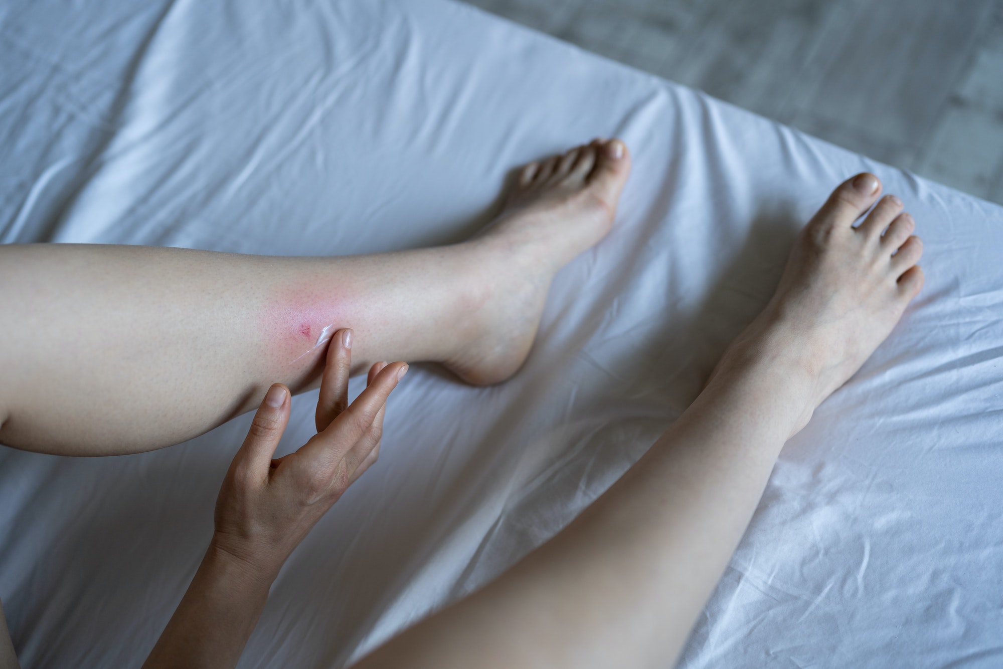 Asian female touches her leg after being bitten by mosquito at home suffering from allergic reaction